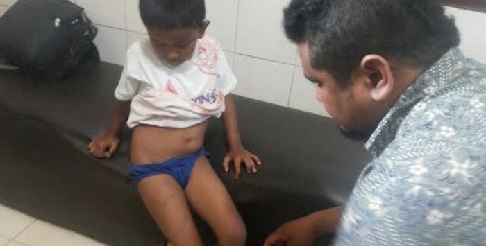 
KORBAN KDRT: IA menunjukkan bekas luka memar di kedua pahanya akibat penyiksaan oleh ayahnya.

